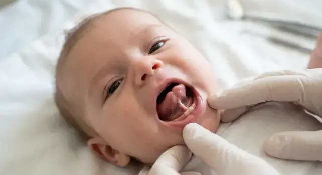 Pediatric dental examination of an infant showing a short lingual frenulum causing tongue tie (ankyloglossia).